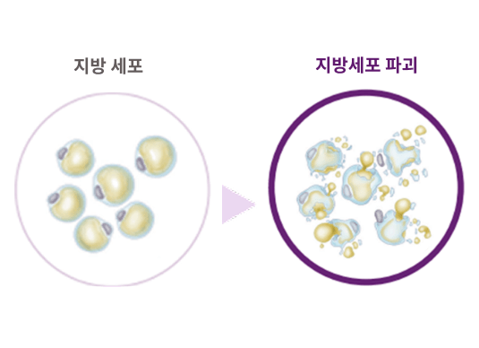 지방세포 파괴 (Adipocytolysis)