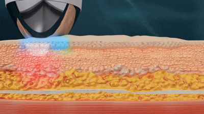 POINT 3. 10Hz 집속초음파