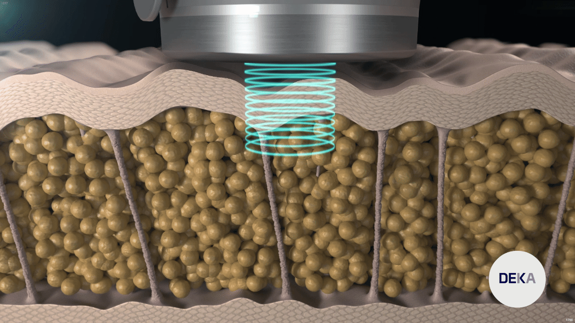 POINT 2. 지방세포 분해