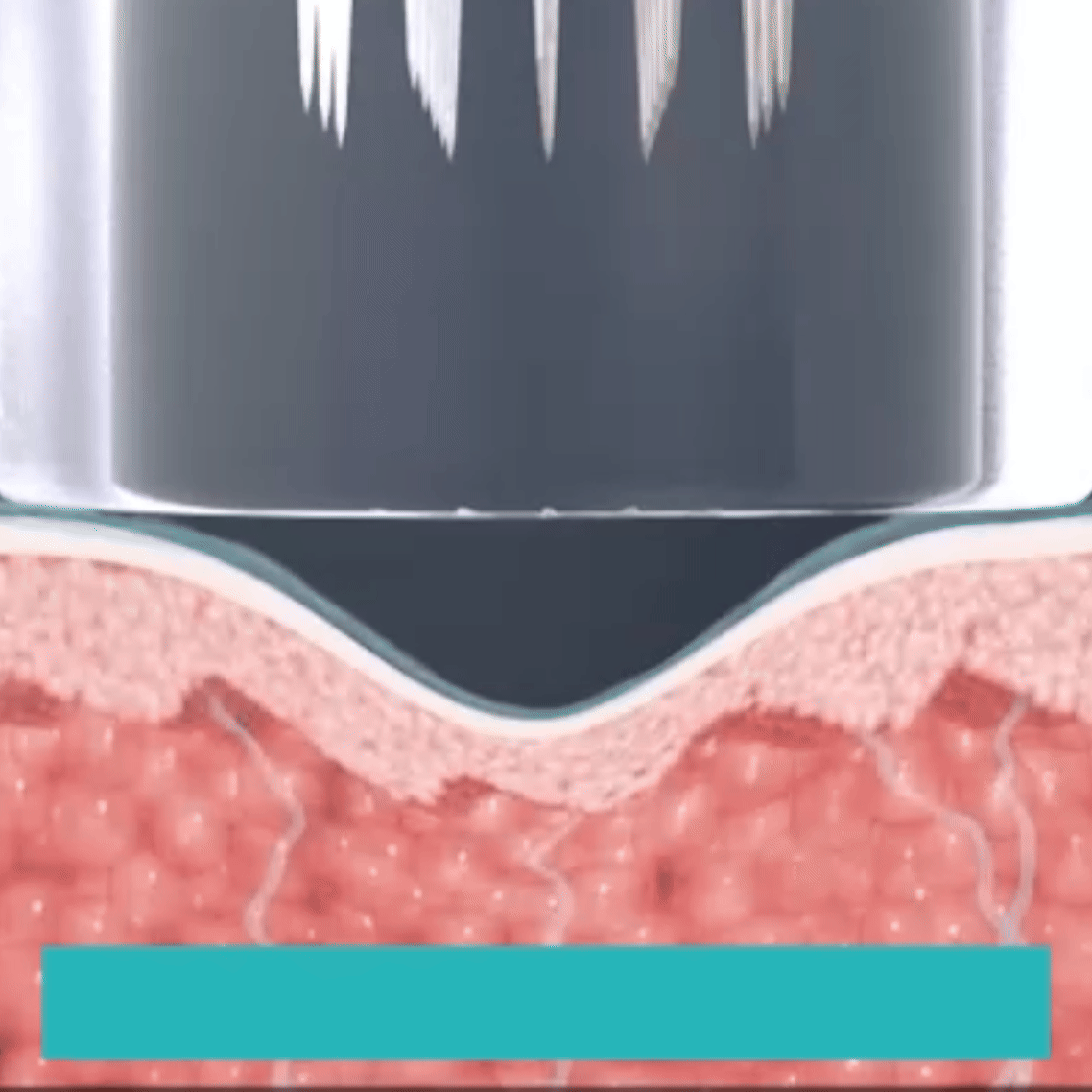 두 가지 핸드피스 - 침습형 고주파